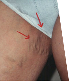 Sclerotherapy of Vulvar/Perineal Varicose Veins
