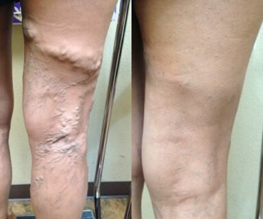 Thrombophlebitis in human leg. Painful inflamation of the leg veins. Medical issue