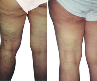 Treatment of varicose before and after