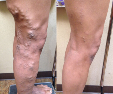 Foam Scleortherapy Of Varicose Veins