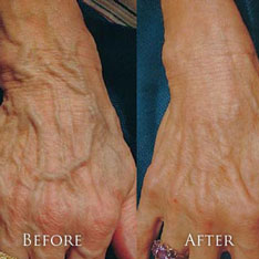Sclerotherapy Of Bulging Vein Back Of Hands