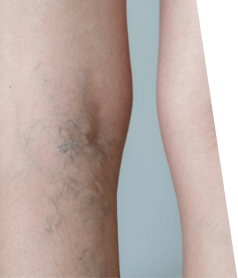 Spider Veins Sclerotherapy