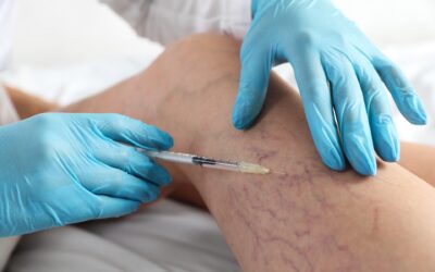 Sclerotherapy for Varicose & Spider Veins: A Complete Guide to Clearer Skin
