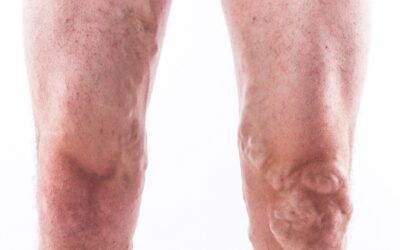 Varicose Veins Explained: Causes, Symptoms, and Treatment That Works