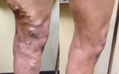 Deep Vein Thrombosis (DVT): Causes, Warning Signs, and When to Seek Help